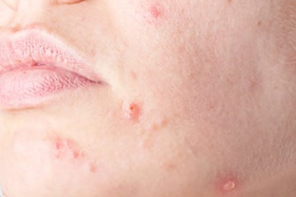 اکتینیک کراتوز