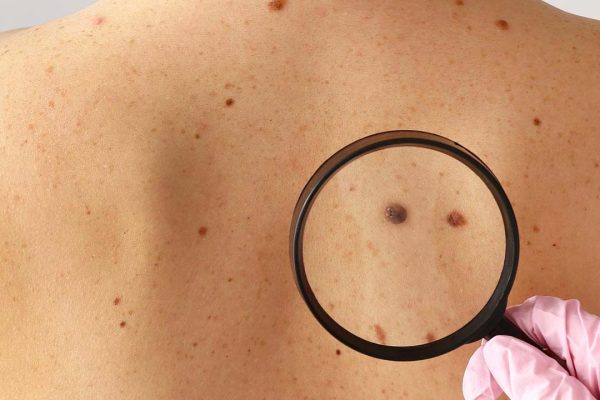 تشخیص و پیشگیری از سرطان پوست